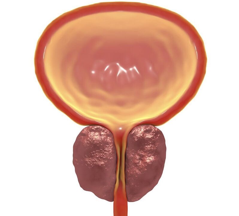 chronic prostatitis