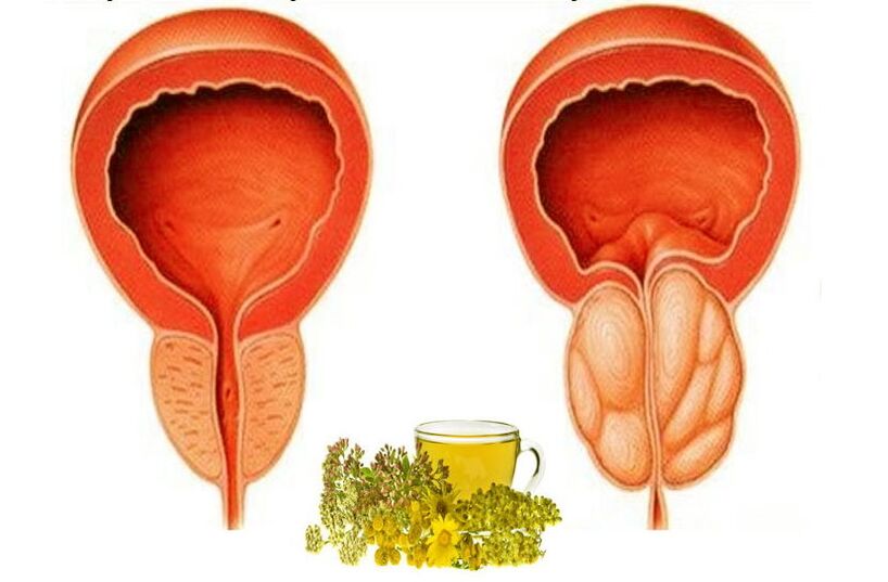 Health and prostate pain