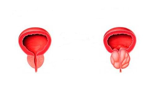 healthy prostate and inflammation with prostatitis